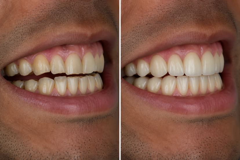 Representative paired treatment visualization for Occlusal Disease Treatment