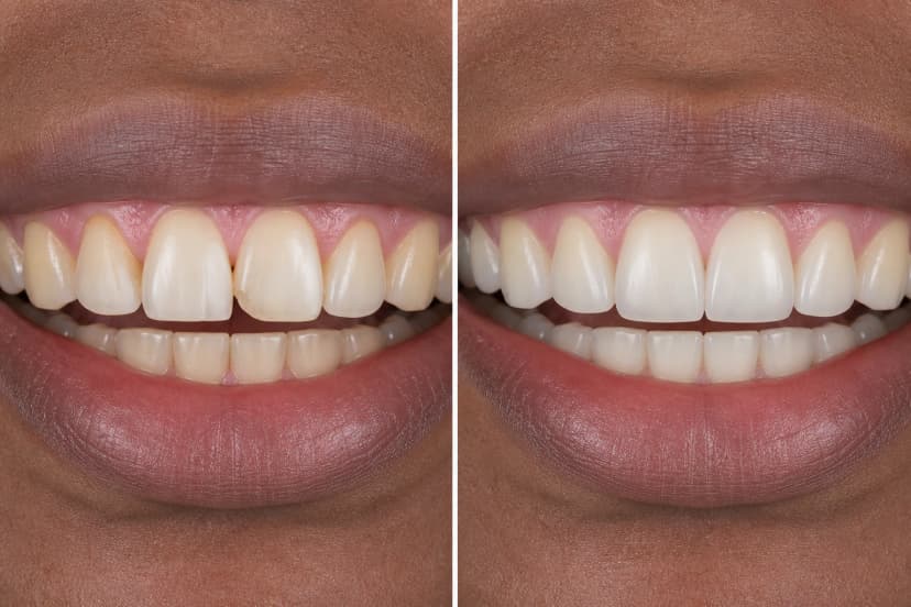 Representative paired treatment visualization for Smile Makeovers