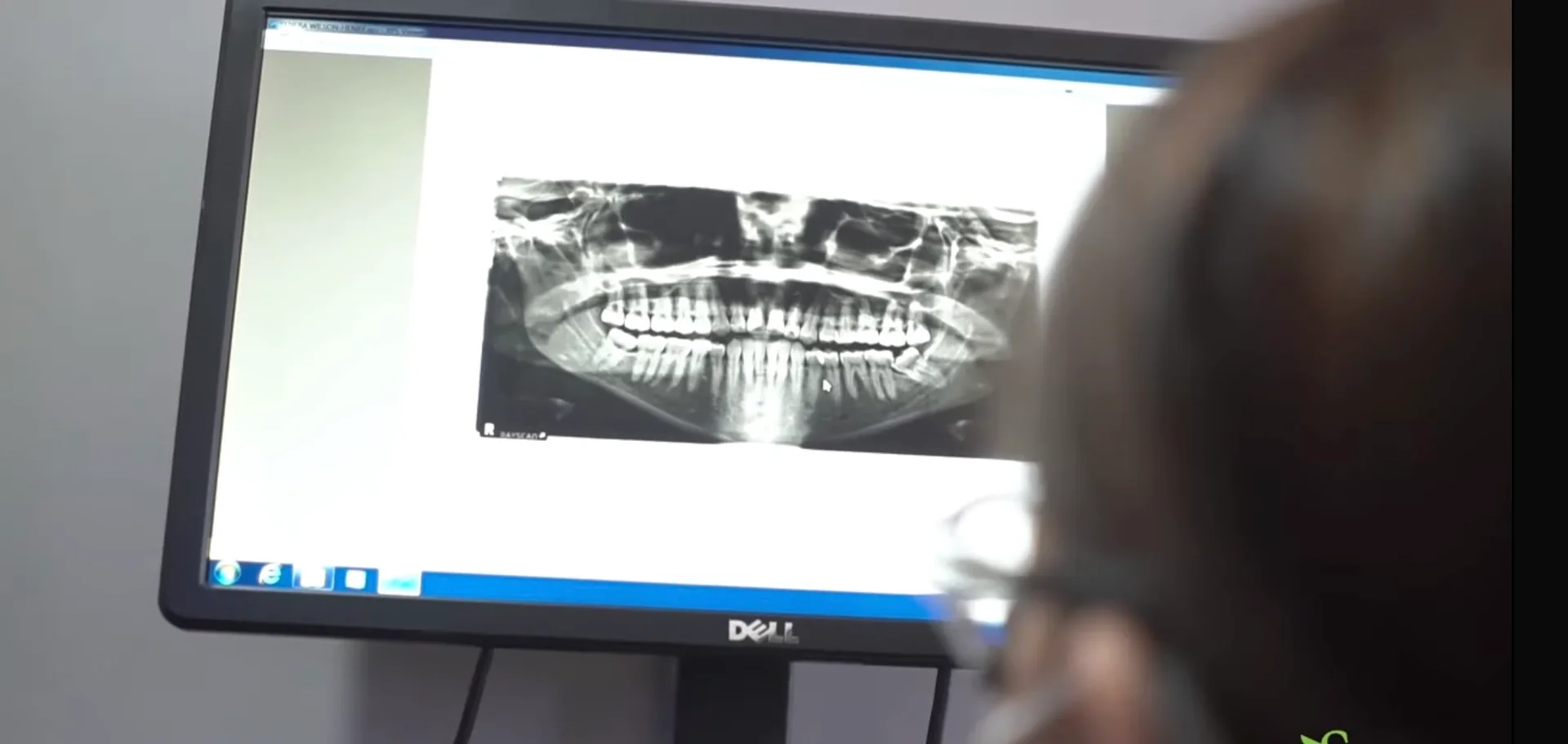 A team member viewing a panoramic dental X-ray on a monitor at Elite Smiles